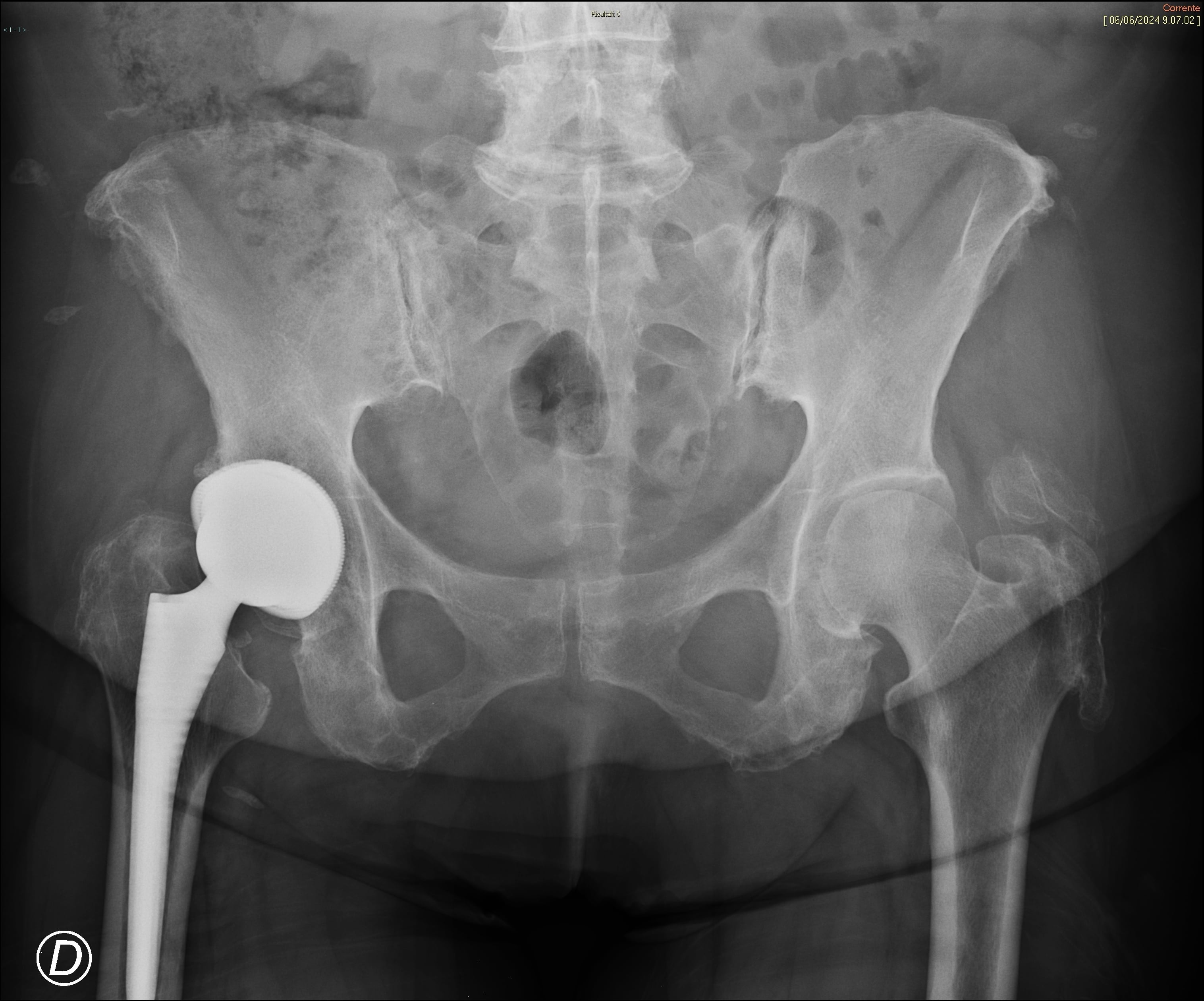 pathological,female,pelvis.,right,hip,prosthesis,results